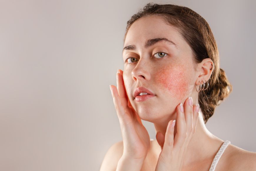 All You Need to Know About Rosacea All You Need to Know About Rosacea