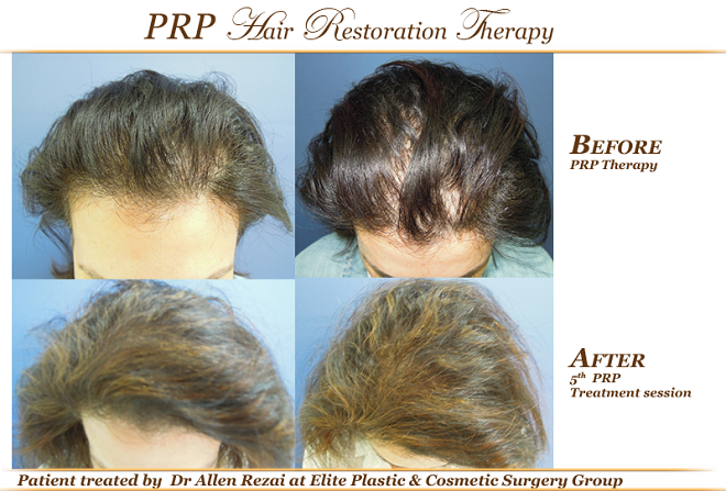 Prp For Hair Loss Reviews Hairstyles Ideas