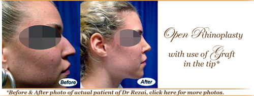 Before and after rhinoplasty elite plastic and cosmetic surgery