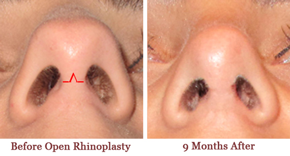 Rhinoplasty elite plastic cosmetic surgery 3