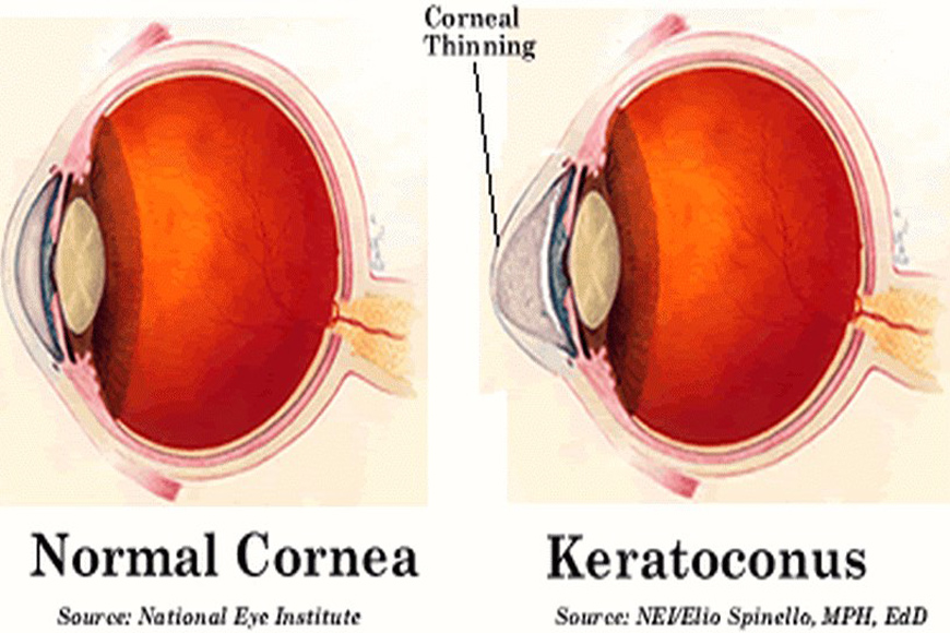 Keratoconus: Facts and Treatments Options in Dubai Keratoconus: Facts and Treatments Options in Dubai