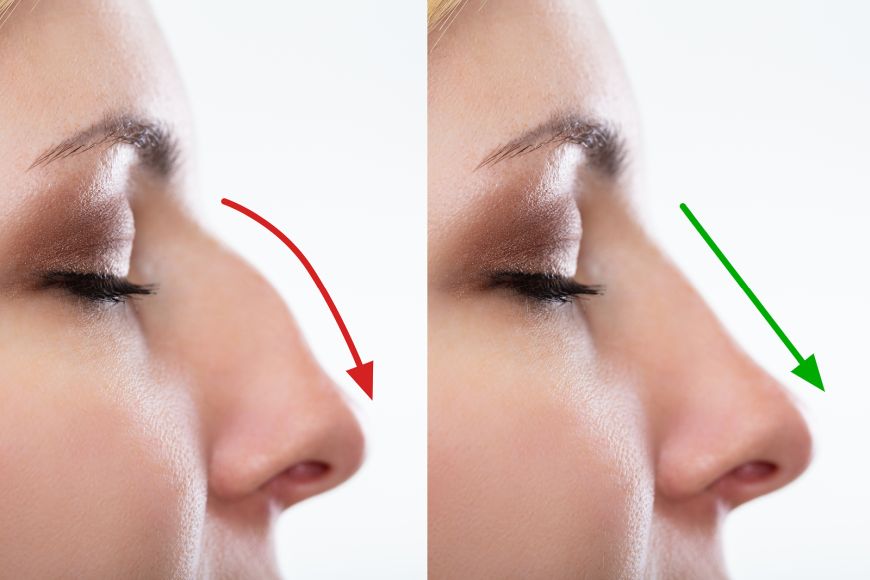 Non-surgical nose job in Dubai at Aesthetica Clinic Non-surgical nose job in Dubai at Aesthetica Clinic