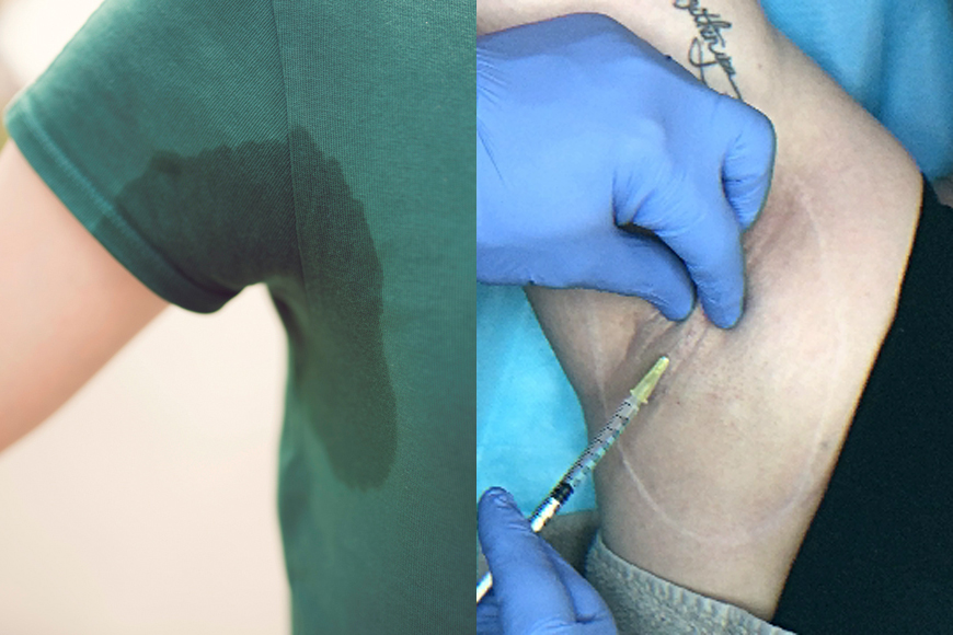 Botox for Excessive Sweat and Hyperhidrosis in Dubai Botox for Excessive Sweat and Hyperhidrosis in Dubai