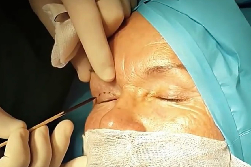 Blepharoplasty in Dubai Blepharoplasty in Dubai