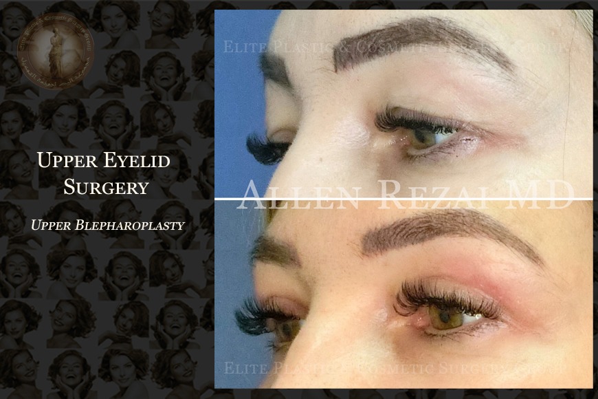 What to expect from eye lid surgery in Dubai What to expect from eye lid surgery in Dubai