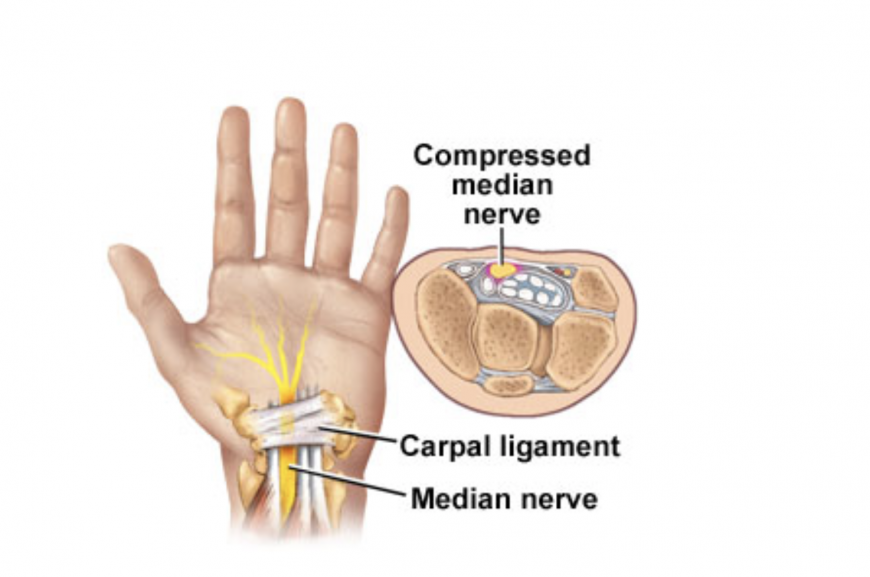 Carpal tunnel syndrome in Dubai Carpal tunnel syndrome in Dubai