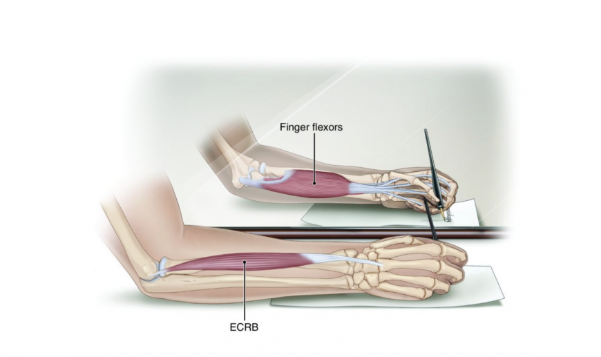 Golfer's elbow Golfer's elbow