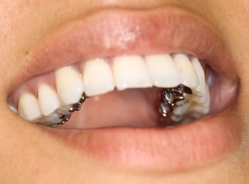 The pros and cons of invisible braces The pros and cons of invisible braces