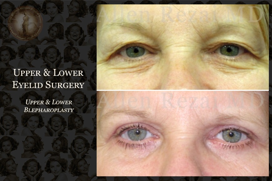 Where to get Blepharoplasty eye lid surgery in Dubai Blepharoplasty surgeon in Dubai
