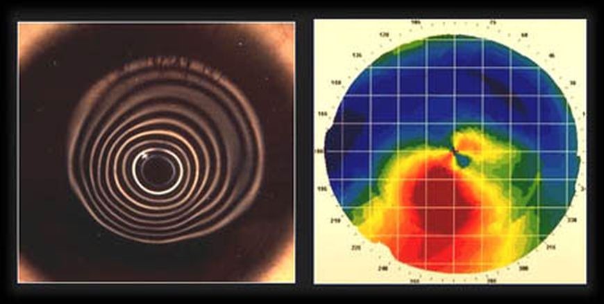 Keratoconus: Facts and Treatments Options in Dubai Keratoconus: Facts and Treatments Options in Dubai