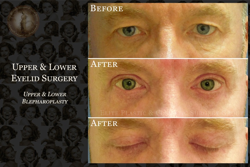 Blepharoplasty in Dubai | Elite Plastic and Cosmetic Surgery Group Clinic Blepharoplasty in Dubai | Elite Plastic and Cosmetic Surgery Group Clinic