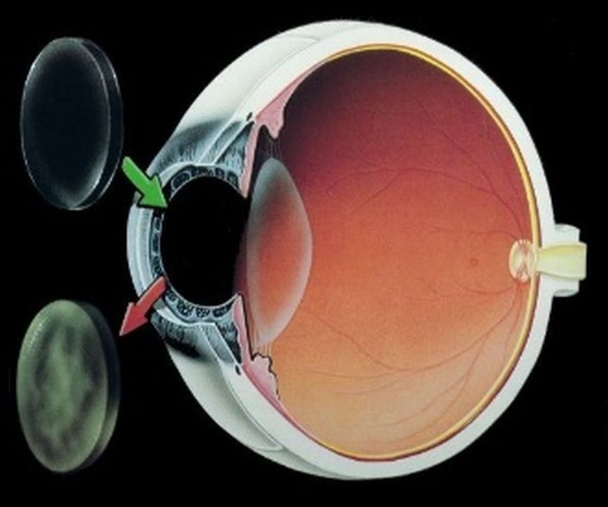 Keratoconus: Facts and Treatments Options in Dubai Keratoconus: Facts and Treatments Options in Dubai