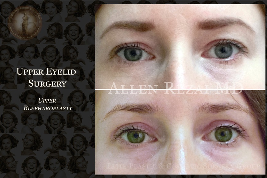 Blepharoplasty eye lid surgery in Dubai Blepharoplasty eye lid surgery in Dubai
