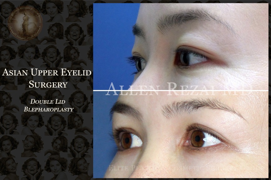 Blepharoplasty in Dubai Blepharoplasty in Dubai