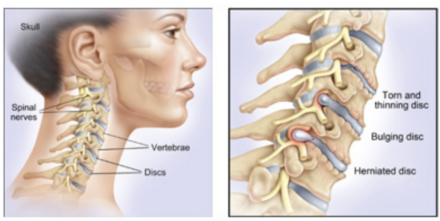 herniated disks herniated disks