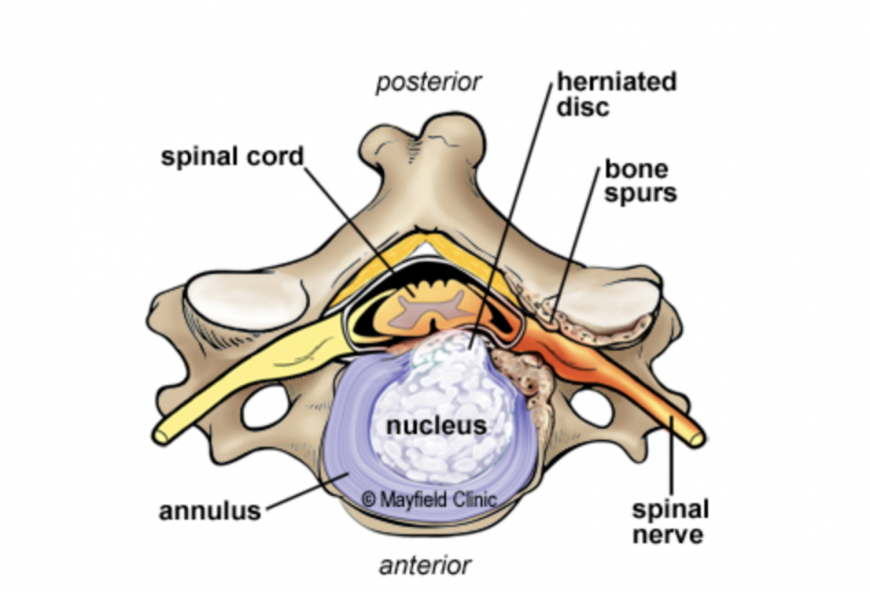 herniated disks herniated disks