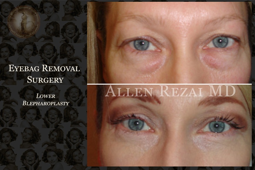 Best Blepharoplasty surgeon in Dubai Best Blepharoplasty surgeon in Dubai