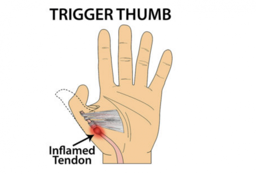 Trigger thumb Trigger thumb