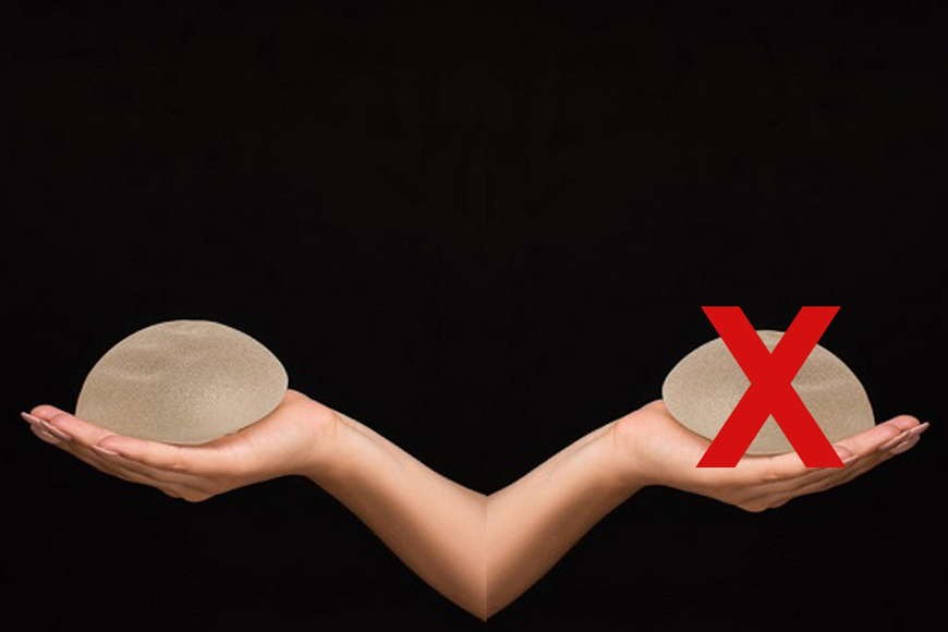 Breast Uplift / Lift With or Without Implants Breast Uplift / Lift With or Without Implants
