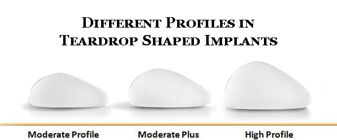 Different Profiles in Teardrop Shaped Implants Different Profiles in Teardrop Shaped Implants