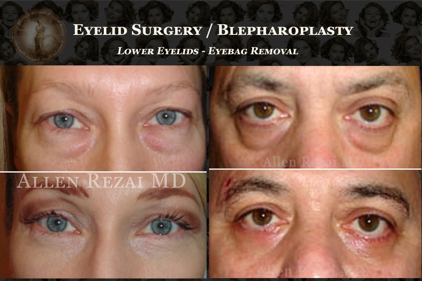 Read This If You’re Considering Blepharoplasty in Dubai Read This If You’re Considering Blepharoplasty in Dubai