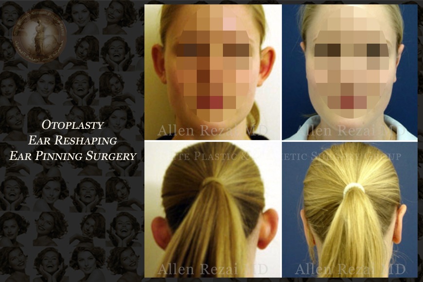 Otoplasty ear reshaping surgery in Dubai | Elite Plastic & Cosmetic Surgery Group Otoplasty ear reshaping surgery in Dubai | Elite Plastic & Cosmetic Surgery Group