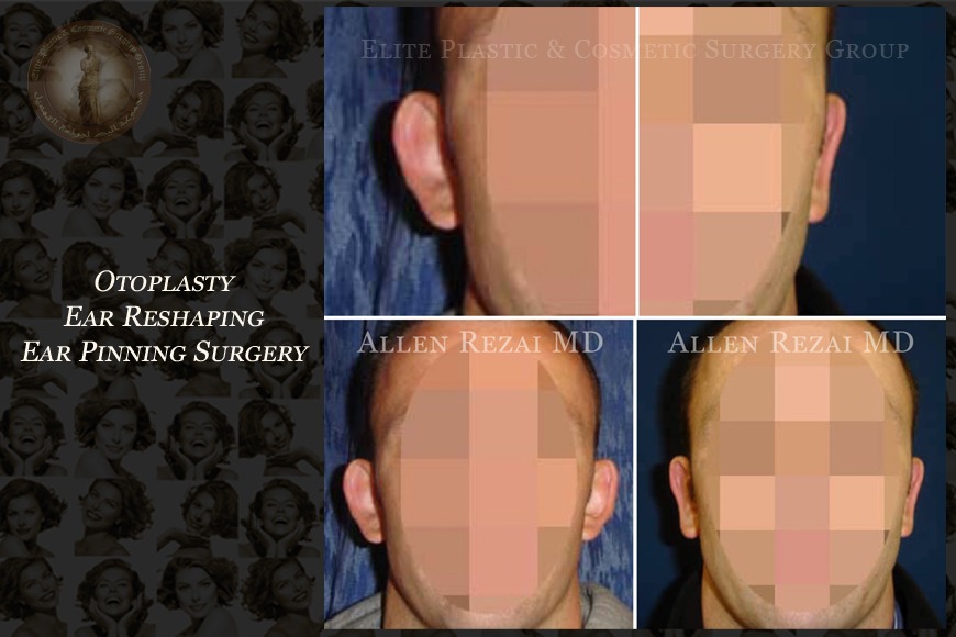 Otoplasty ear reshaping surgery in Dubai | Elite Plastic & Cosmetic Surgery Group Otoplasty ear reshaping surgery in Dubai | Elite Plastic & Cosmetic Surgery Group