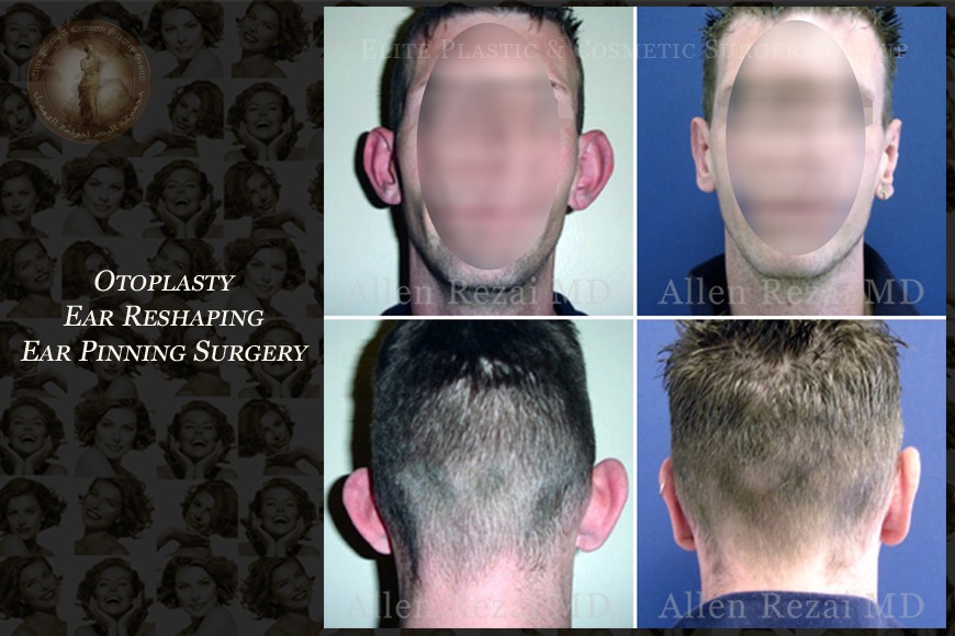 Otoplasty ear reshaping surgery in Dubai | Elite Plastic & Cosmetic Surgery Group Otoplasty ear reshaping surgery in Dubai | Elite Plastic & Cosmetic Surgery Group