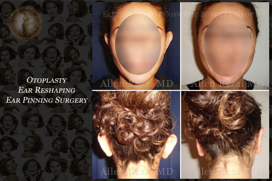 Otoplasty ear reshaping surgery in Dubai | Elite Plastic & Cosmetic Surgery Group Otoplasty ear reshaping surgery in Dubai | Elite Plastic & Cosmetic Surgery Group
