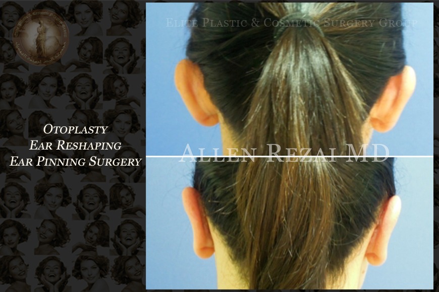 Otoplasty ear reshaping surgery in Dubai | Elite Plastic & Cosmetic Surgery Group Otoplasty ear reshaping surgery in Dubai | Elite Plastic & Cosmetic Surgery Group