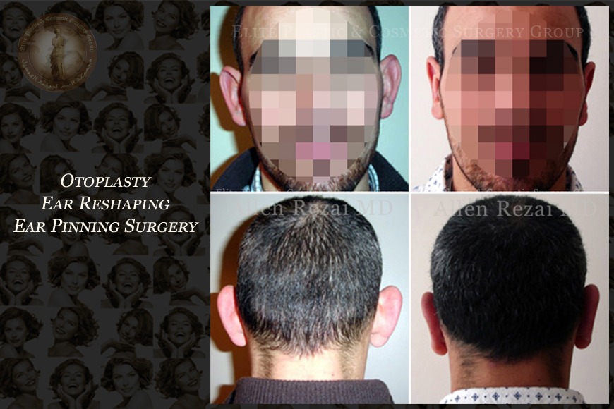 Otoplasty ear reshaping surgery in Dubai | Elite Plastic & Cosmetic Surgery Group Otoplasty ear reshaping surgery in Dubai | Elite Plastic & Cosmetic Surgery Group