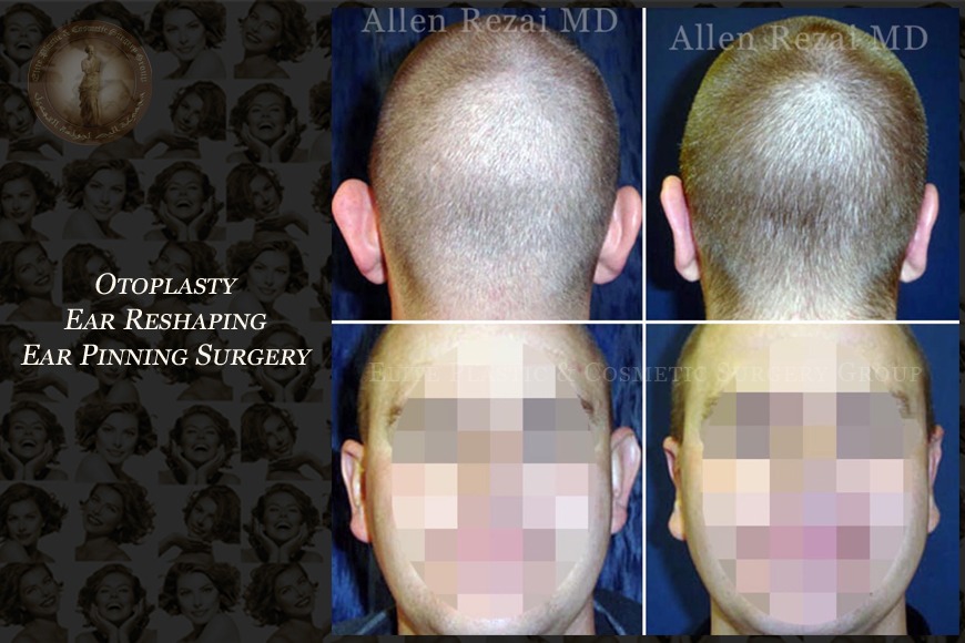 Otoplasty ear reshaping surgery in Dubai | Elite Plastic & Cosmetic Surgery Group Otoplasty ear reshaping surgery in Dubai | Elite Plastic & Cosmetic Surgery Group