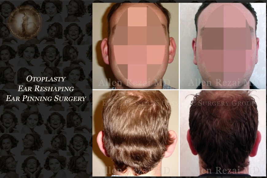 Otoplasty ear reshaping surgery in Dubai | Elite Plastic & Cosmetic Surgery Group Otoplasty ear reshaping surgery in Dubai | Elite Plastic & Cosmetic Surgery Group