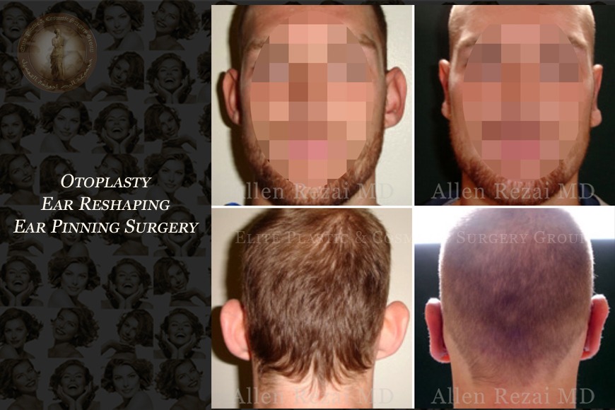 Otoplasty ear reshaping surgery in Dubai | Elite Plastic & Cosmetic Surgery Group Otoplasty ear reshaping surgery in Dubai | Elite Plastic & Cosmetic Surgery Group
