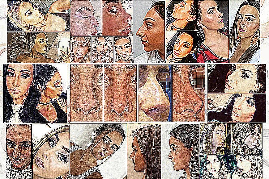 Rhinoplasty in Dubai | Elite Cosmetic and Plastic Surgery in Dubai Rhinoplasty in Dubai | Elite Cosmetic and Plastic Surgery in Dubai