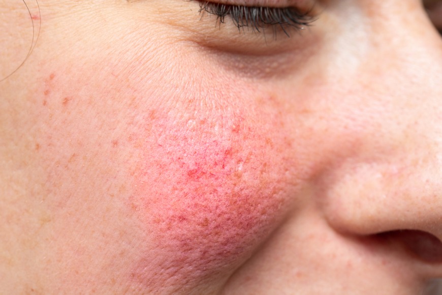 Rosacea in Dubai: How to Identify and Treat It According to Experts