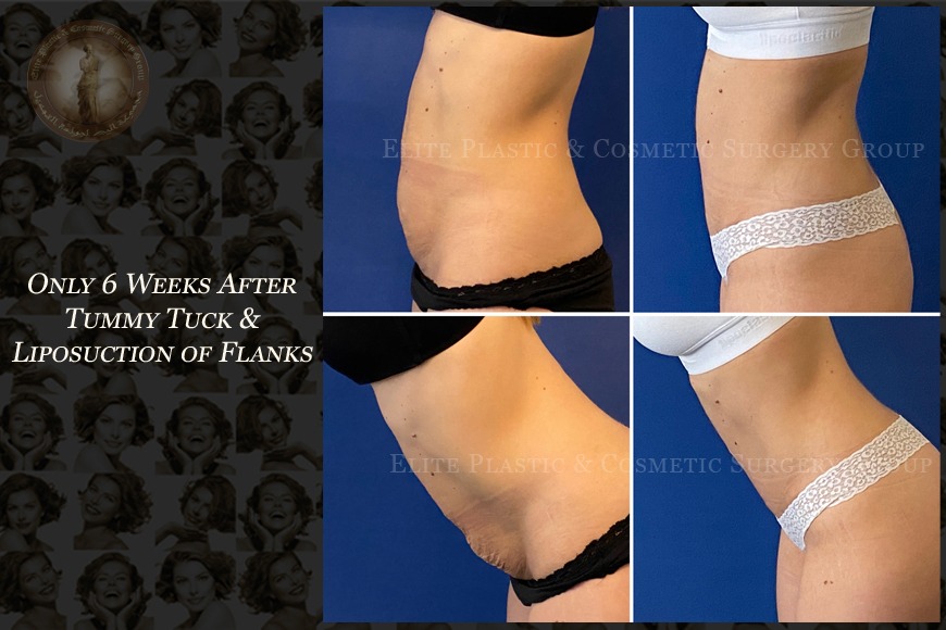 Best tummy tuck surgeon in Dubai Best tummy tuck surgeon in Dubai