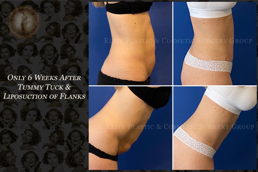 Liposuction in Dubai Tummy tuck procedure in Dubai