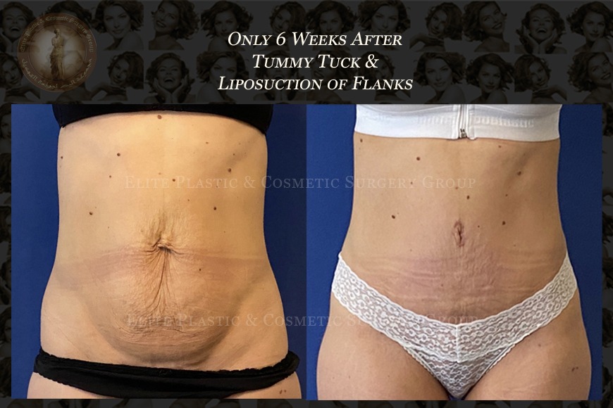 Tummy tuck in Dubai: Where to get it done Tummy tuck in Dubai: Where to get it done