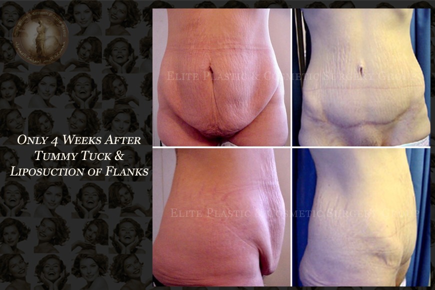 Abdominoplasty surgery in Dubai Abdominoplasty surgery in Dubai