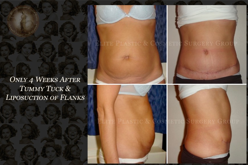 Abdominoplasty surgeon in Dubai Abdominoplasty surgeon in Dubai