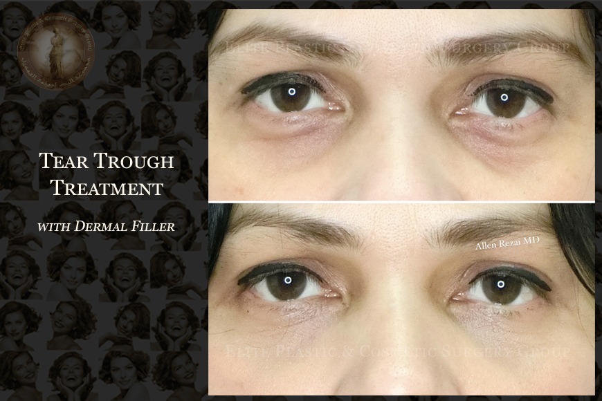Blepharoplasty eye lid surgery in Dubai Blepharoplasty eye lid surgery in Dubai