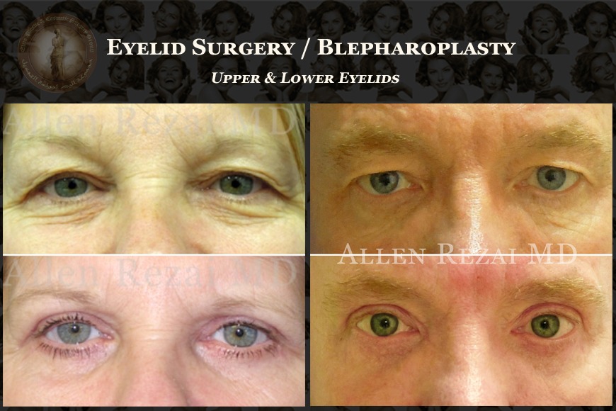 Read This If You’re Considering Blepharoplasty in Dubai Read This If You’re Considering Blepharoplasty in Dubai