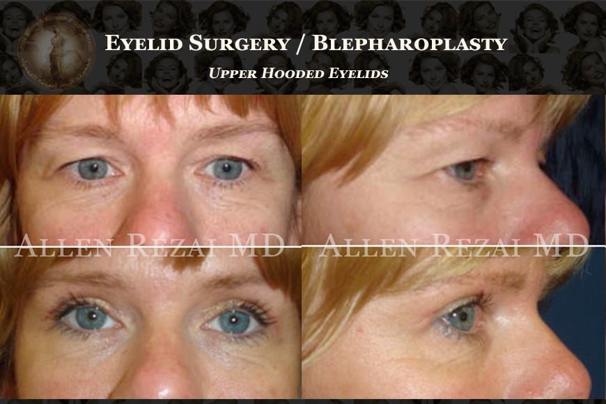 Read This If You’re Considering Blepharoplasty in Dubai Read This If You’re Considering Blepharoplasty in Dubai