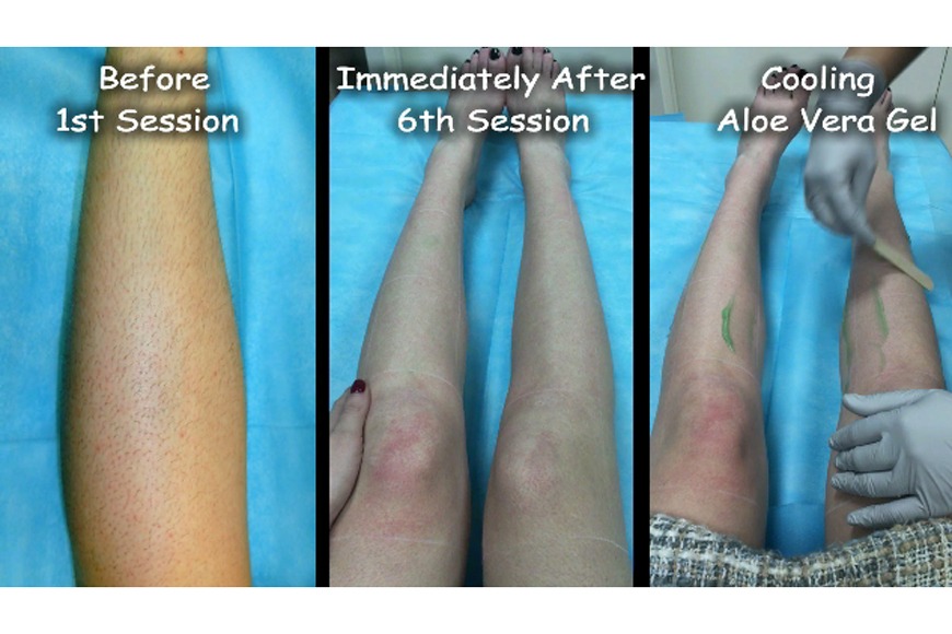 Review: Laser Hair Removal in Dubai Review: Laser Hair Removal in Dubai