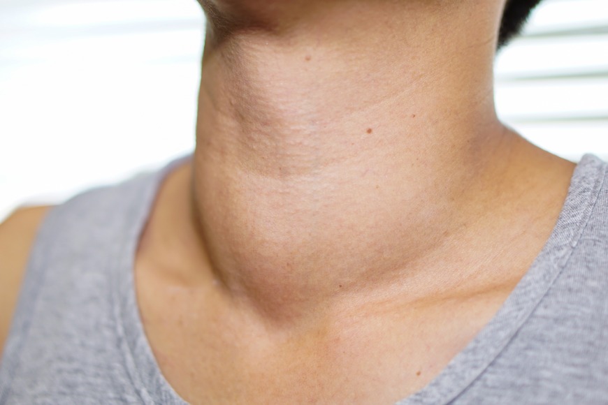 Thyroid problems in Dubai