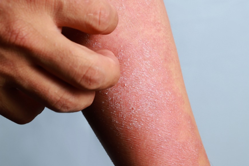 Eczema treatment in Dubai Eczema treatment in Dubai