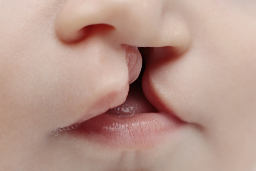 A cleft occurs when the sides of the lip and roof of the mouth don’t fuse together properly A cleft occurs when the sides of the lip and roof of the mouth don’t fuse together properly