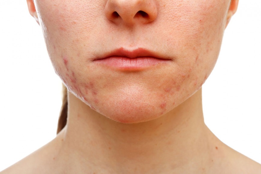 Adult Acne Adult Acne