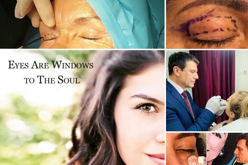 Read This If You’re Considering Blepharoplasty in Dubai Read This If You’re Considering Blepharoplasty in Dubai